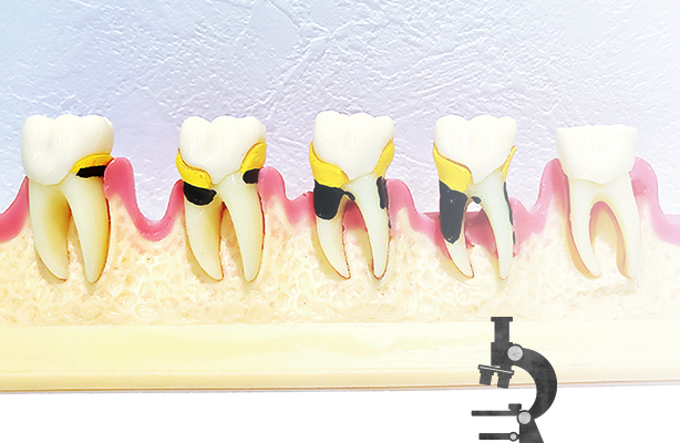 歯周病検査について