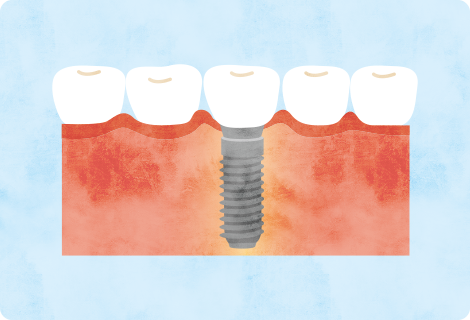 インプラント