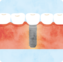 インプラント